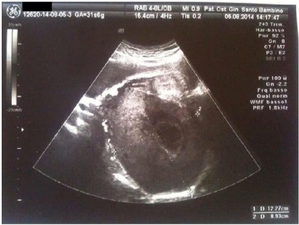Pregnancy luteoma: ultrasound