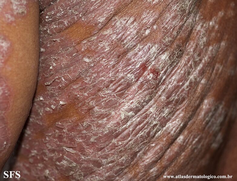 File:Psoriasis (Dermatology Atlas 105).jpg