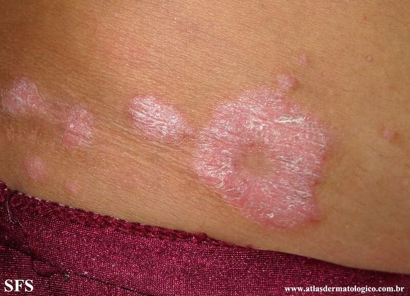 File:Psoriasis (Dermatology Atlas 91).jpg