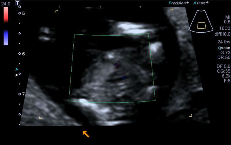 File:1st trimester nuchal-morphology ultrasound (Radiopaedia 44706-48477 Heart views cine with colour 146).jpg