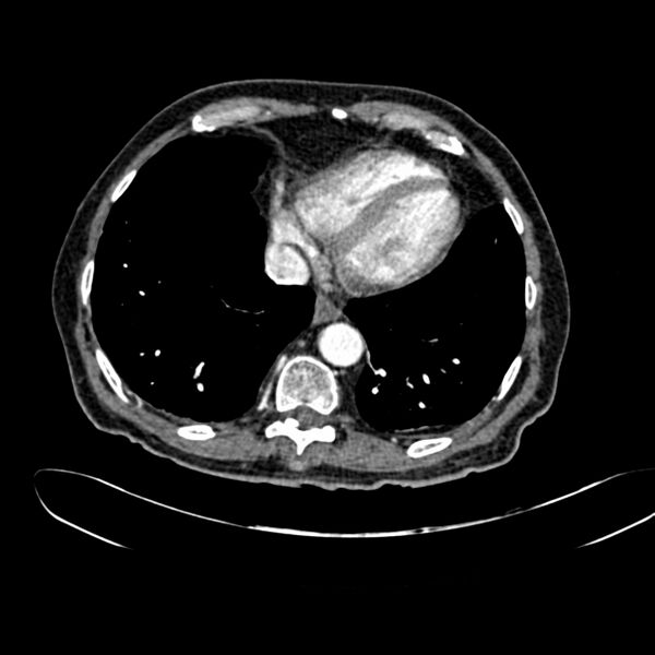 File:Abdominal aortic aneurysm (Radiopaedia 75131-86203 Axial C+ arterial phase 5).jpg