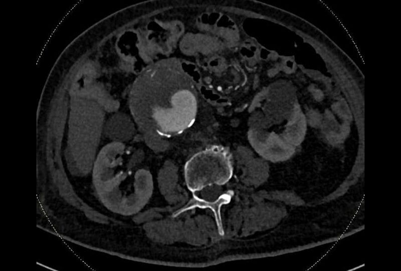 File:Abdominal aortic aneurysm with thrombus fissuration (Radiopaedia 73192-83919 Axial C+ arterial phase 90).jpg