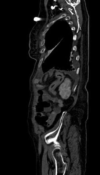 File:Abdominal aortic aneurysm with thrombus fissuration (Radiopaedia 73192-83919 Sagittal C+ arterial phase 13).jpg