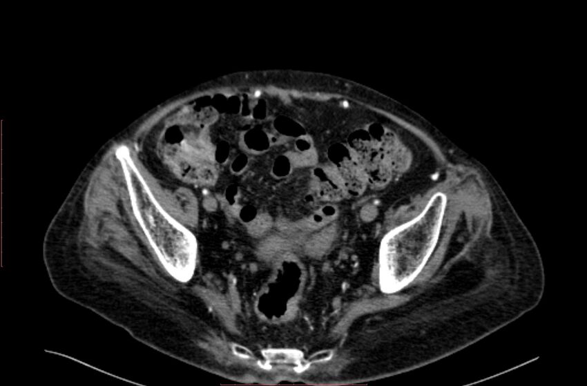 Abdominal aortic interposition tube graft and aneurysm thrombosis (Radiopaedia 71438-81857 Axial C+ arterial phase 196).jpg