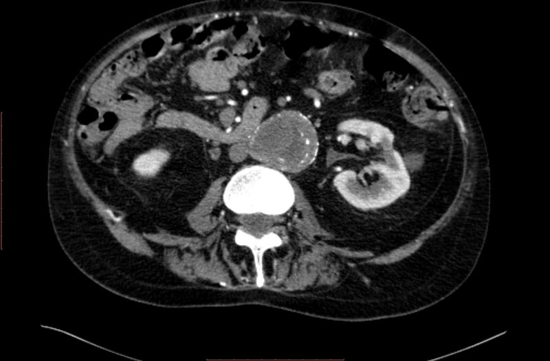 File:Abdominal aortic interposition tube graft and aneurysm thrombosis (Radiopaedia 71438-81857 Axial C+ arterial phase 78).jpg