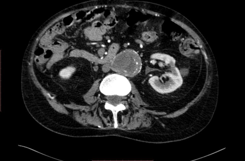 Abdominal aortic interposition tube graft and aneurysm thrombosis (Radiopaedia 71438-81857 Axial C+ arterial phase 78).jpg
