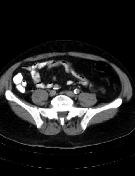 File:Abdominal lymphoma - with sandwich sign (Radiopaedia 53486-59492 Axial C+ portal venous phase 35).jpg