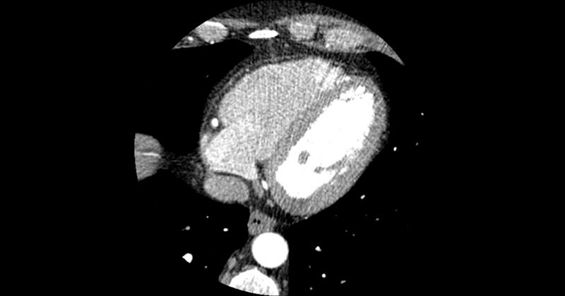 File:Aberrant left main coronary artery (ALMCA) arising from the right sinus with interarterial course (Radiopaedia 63251-71814 Axial C+ arterial phase 150).JPG
