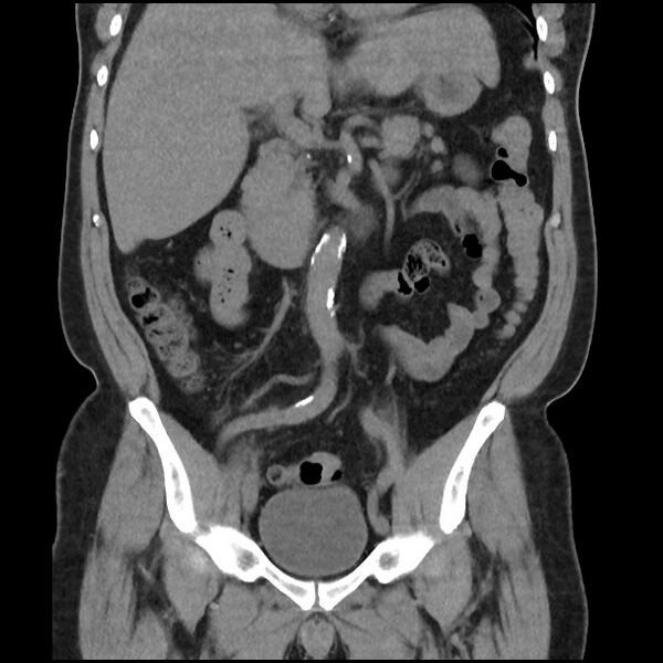 File:Active colonic bleed on CT (Radiopaedia 49765-55025 Coronal non-contrast 27).jpg