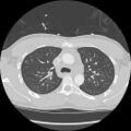 Active right ventricular cardiac sarcoidosis (Radiopaedia 55596-62101 Axial lung window 11).jpg