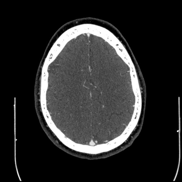 File:Acute A3 occlusion with ACA ischemic penumbra (CT perfusion) (Radiopaedia 72036-82527 Axial C+ arterial phase thins 2).jpg