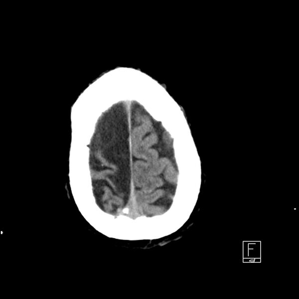 File:Acute ICA ischemic penumbra due to high-grade CCA stenosis (CT perfusion) (Radiopaedia 72038-82529 Axial non-contrast 43).jpg