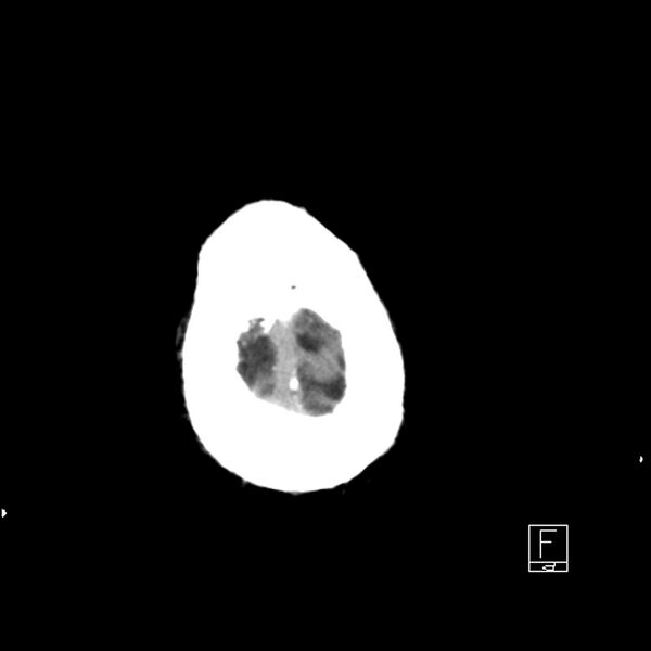 File:Acute ICA ischemic penumbra due to high-grade CCA stenosis (CT perfusion) (Radiopaedia 72038-82529 Axial non-contrast 46).jpg