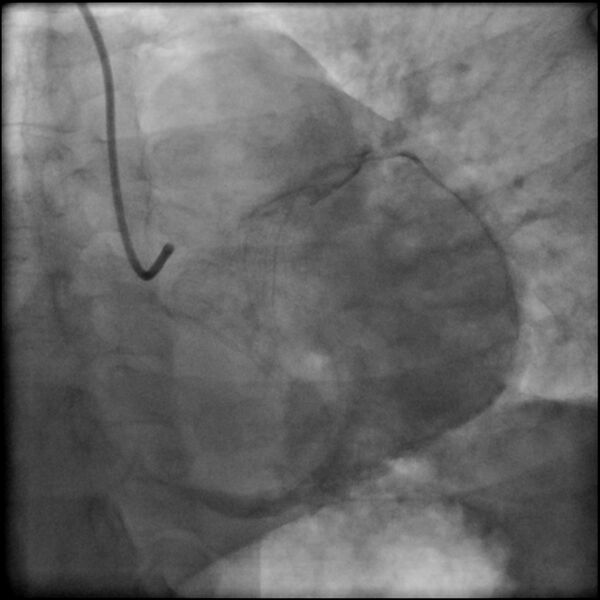 File:Acute anteroseptal myocardial infarction (Radiopaedia 68409-77946 LAO caudal (spider view) LAD and CX 79).jpg