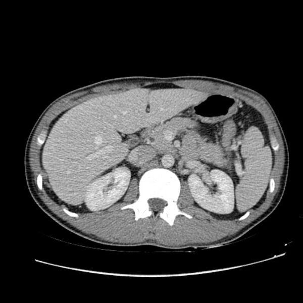 File:Acute appendicitis (Radiopaedia 27049-27227 Axial C+ portal venous phase 23).jpg