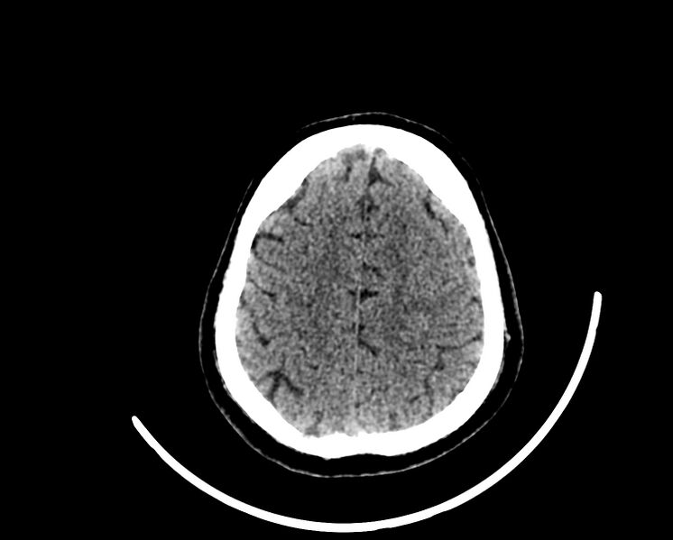 File:Acute cerebral infarct (Radiopaedia 35604-37123 Axial non-contrast 82).jpg