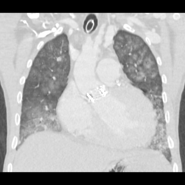 File:Acute diffuse alveolar hemorrhage (Radiopaedia 41323-44158 Coronal lung window 16).jpg