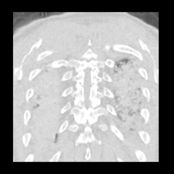 File:Acute diffuse alveolar hemorrhage (Radiopaedia 41323-44158 Coronal lung window 52).jpg