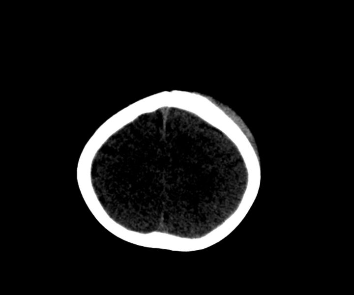 File:Acute epidural hematoma (Radiopaedia 63659-72335 Axial subdural window 20).jpg