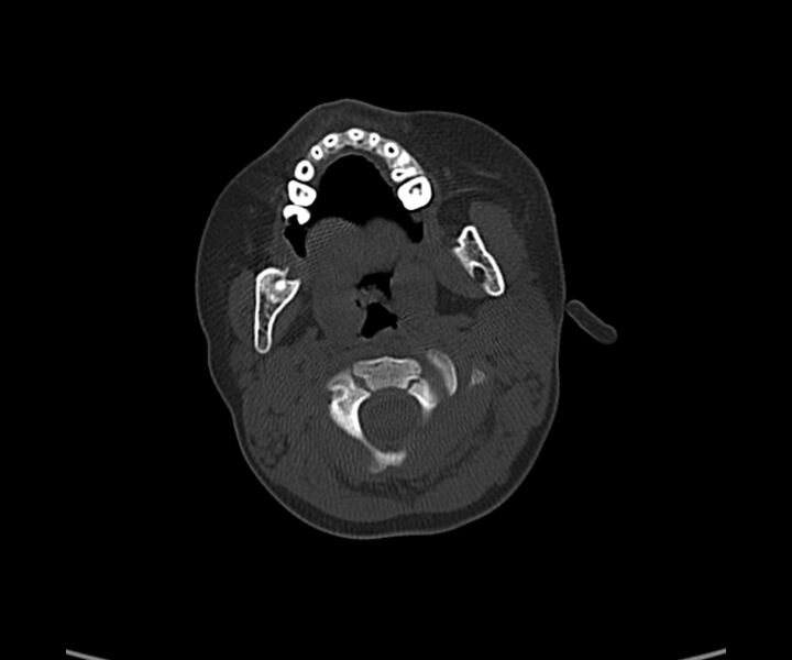 File:Acute hemorrhagic contusion (Radiopaedia 63660-72336 Axial bone window 3).jpg
