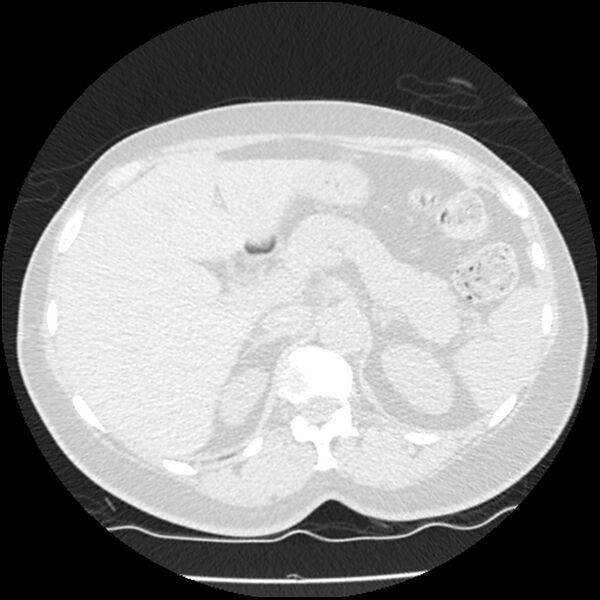 File:Acute interstitial pneumonitis (Radiopaedia 45404-49444 Axial lung window 101).jpg