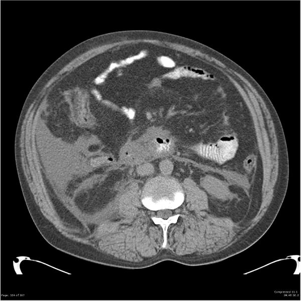 File:Acute pancreatitis (Radiopaedia 19135-19116 Axial non-contrast 28).jpg