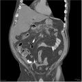 Acute pancreatitis (Radiopaedia 19135-19116 Coronal non-contrast 12).jpg