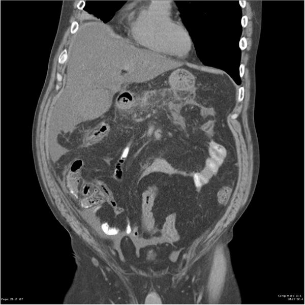 File:Acute pancreatitis (Radiopaedia 19135-19116 Coronal non-contrast 12).jpg