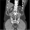 Acute pancreatitis (Radiopaedia 19135-19116 Coronal non-contrast 39).jpg