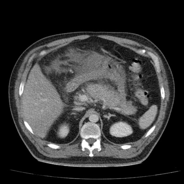 File:Acute pancreatitis (Radiopaedia 26663-26813 Axial C+ portal venous phase 25).jpg