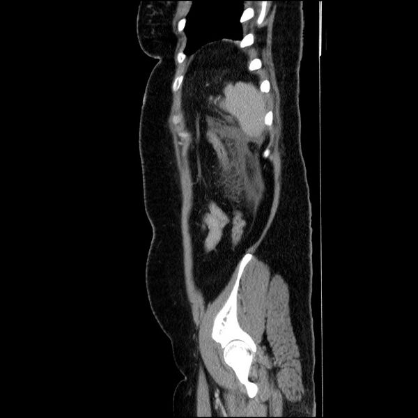 File:Acute pancreatitis (Radiopaedia 69236-79012 Sagittal C+ portal venous phase 25).jpg