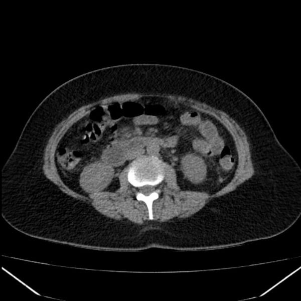 File:Acute pancreatitis - Balthazar C (Radiopaedia 26569-26714 Axial non-contrast 47).jpg