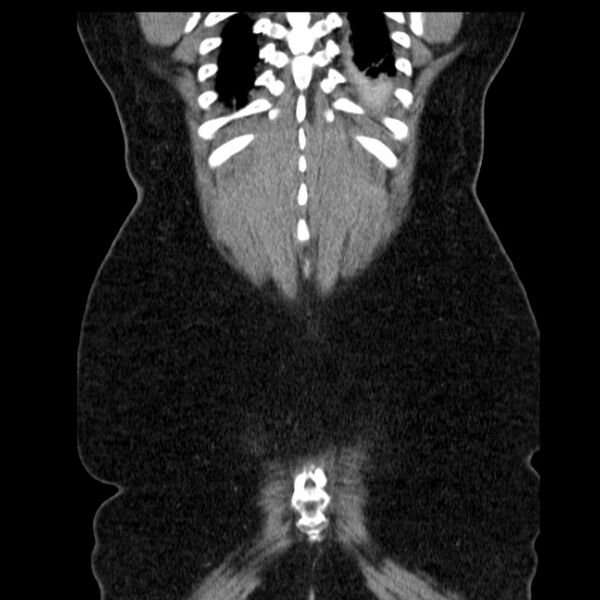 File:Acute pancreatitis - Balthazar C (Radiopaedia 26569-26714 Coronal C+ portal venous phase 62).jpg