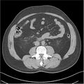 Acute pancreatitis - mild (Radiopaedia 27796-28033 Axial non-contrast 30).jpg