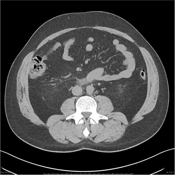 File:Acute pancreatitis - mild (Radiopaedia 27796-28033 Axial non-contrast 30).jpg