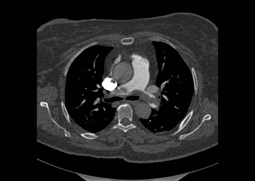 Acute pulmonary embolism (Radiopaedia 29938-30466 Axial C+ CTPA 46).jpg