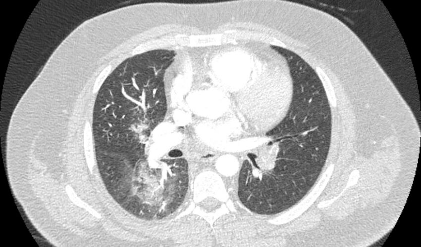 Acute pulmonary embolism with pulmonary infarcts (Radiopaedia 77688-89908 Axial lung window 58).jpg