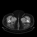 Acute pyelonephritis (Radiopaedia 25657-25837 Axial renal parenchymal phase 90).jpg