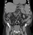 Acute renal failure post IV contrast injection- CT findings (Radiopaedia 47815-52557 Coronal non-contrast 20).jpg