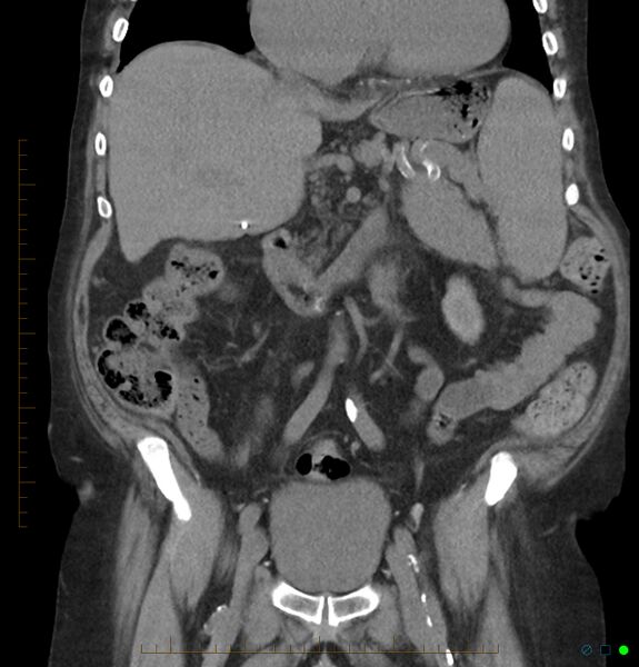 File:Acute renal failure post IV contrast injection- CT findings (Radiopaedia 47815-52557 Coronal non-contrast 20).jpg