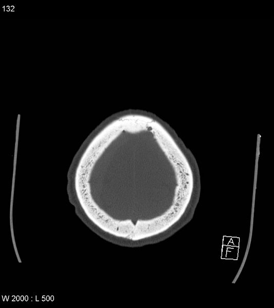 File:Acute subdural hematoma with myelofibrosis (Radiopaedia 52582-58494 Axial bone window 66).jpg