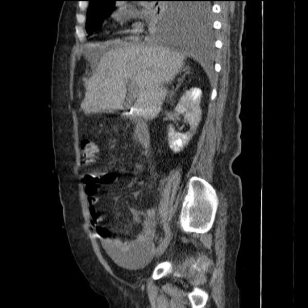 File:Acute tubular necrosis (Radiopaedia 28077-28334 H 34).jpg