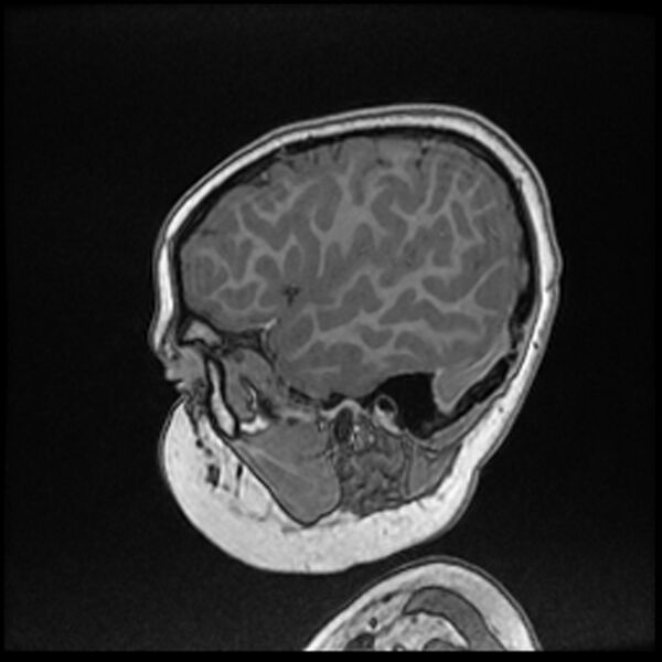 File:Adamantinomatous craniopharyngioma (Radiopaedia 77407-89529 Sagittal T1 C+ 24).jpg