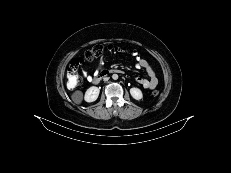 File:Adenocarcinoma of pancreas with hepatic metastasis (Radiopaedia 64332-73122 Axial C+ delayed 48).jpg