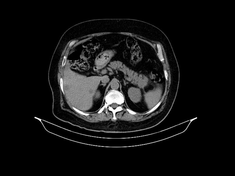 File:Adenocarcinoma of pancreas with hepatic metastasis (Radiopaedia 64332-73122 Axial non-contrast 33).jpg