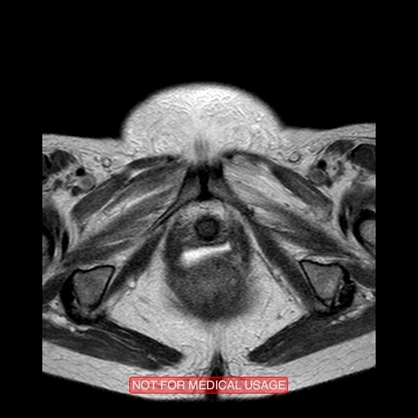 File:Adenocarcinoma of the cervix (Radiopaedia 28373-28615 Axial T2 1).jpg