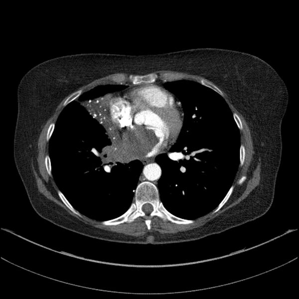 File:Adenocarcinoma of the lung (Radiopaedia 44205-47803 Axial C+ portal venous phase 51).jpg