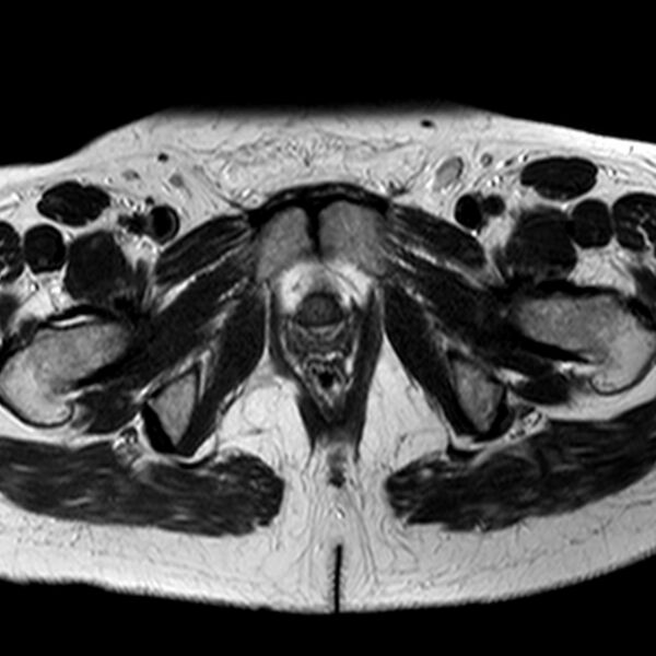 File:Adenomyoma of the uterus (Radiopaedia 9871-10439 Axial T2 5).jpg