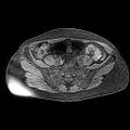 Adenomyoma of the uterus (huge) (Radiopaedia 9870-10438 Axial T1 fat sat 24).jpg