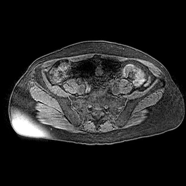 File:Adenomyoma of the uterus (huge) (Radiopaedia 9870-10438 Axial T1 fat sat 24).jpg